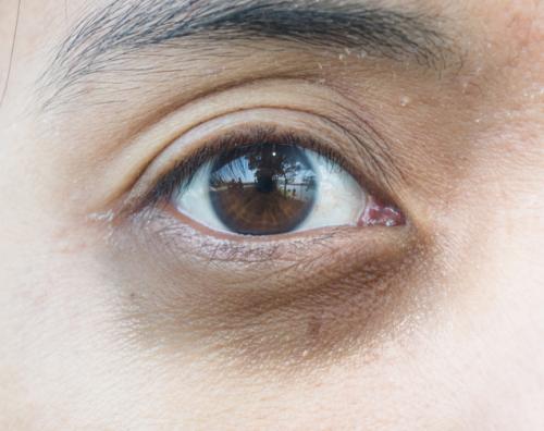 Как избавиться от темных кругов под глазами косметология. Давайте взглянем на анатомическое строение области глаз.