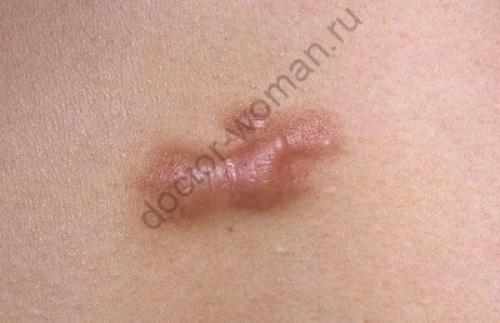 Как избежать появления пятен после прыщей. Какие бывают следы от прыщей