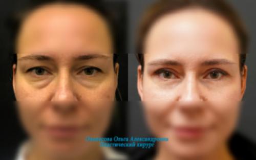 Лимфодренажный массаж лица от отеков. Упражнения для устранения мешков под глазами