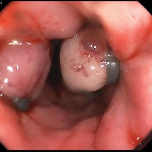 Понимание панкреатита: симптомы, диагностика и лечение 02 Понимание панкреатита: симптомы, диагностика и лечение 02