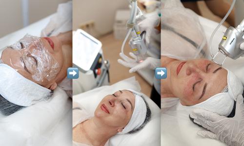 Каковы преимущества лазерной терапии по сравнению с другими методами удаления тёмных кругов под глазами. Лазерная блефаропластика на СО2 лазере