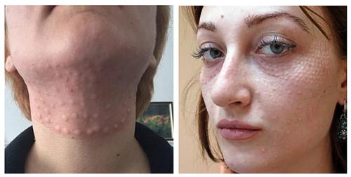 Какие факторы могут способствовать появлению папул. Общие сведения