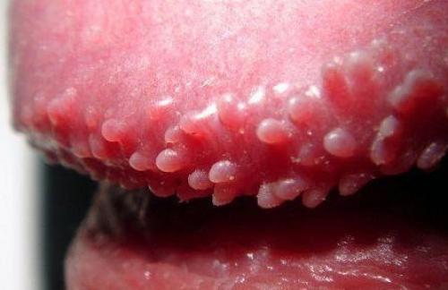 Какие факторы могут способствовать появлению папул. Общие сведения