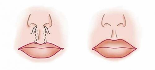 Как убрать морщины вокруг рта. Откуда берутся кисетные морщины вокруг рта 05 Как убрать морщины вокруг рта. Откуда берутся кисетные морщины вокруг рта 05