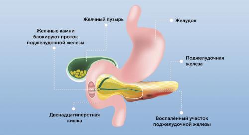 Что такое острый панкреатит и какие его причины. Виды острого панкреатита