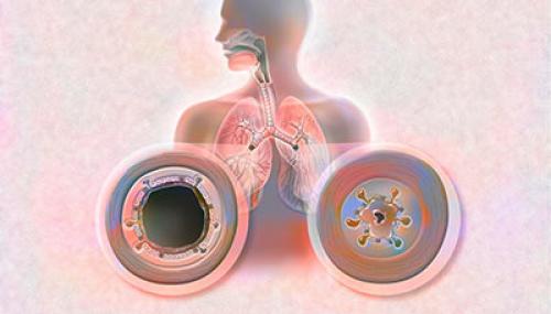 Хронический бронхит у взрослых. Лечение хронического бронхита у взрослых в Москве 04