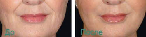 Носогубные складки коррекция. Удаление носогубных складок на лице