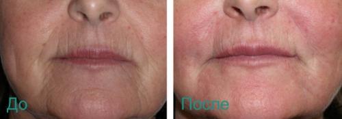 Носогубные складки коррекция. Удаление носогубных складок на лице