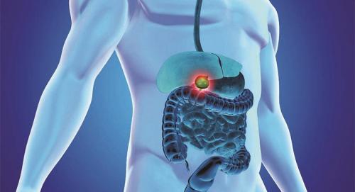 После удаления желчного пузыря долго не живут. Показания к холецистэктомии