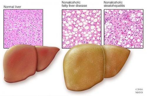Ожирение печени можно ли вылечить. Патогенез жирового гепатоза, неалкогольной жировой болезни печени (НАЖБП) 01