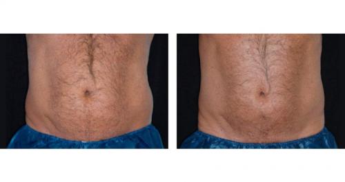 Безоперационная липосакция на аппарате lpg. Липосакция и липофиллинг Body jet 02