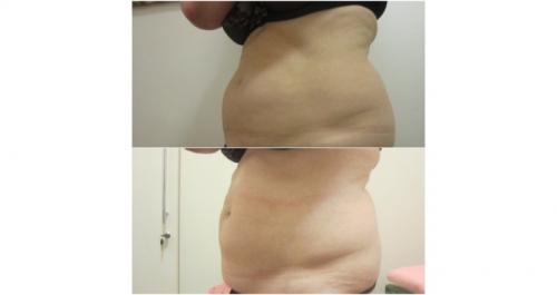 Безоперационная липосакция на аппарате lpg. Липосакция и липофиллинг Body jet 05