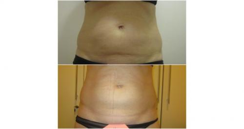 Безоперационная липосакция на аппарате lpg. Липосакция и липофиллинг Body jet 04