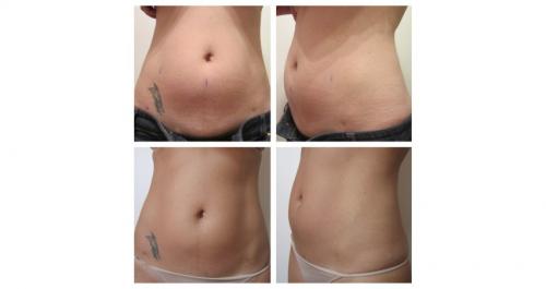 Безоперационная липосакция на аппарате lpg. Липосакция и липофиллинг Body jet 06