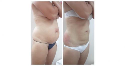 Безоперационная липосакция на аппарате lpg. Липосакция и липофиллинг Body jet 03