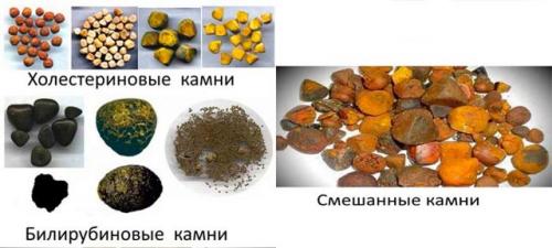 Как я избавилась от камней в желчном пузыре. Когда применяют лекарства