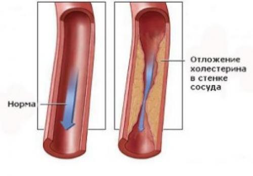 Может ли овёс помочь снизить риск развития атеросклероза. Несколько слов об эффективности фитотерапии