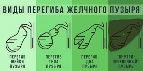Самомассаж для оттока желчи. Что делать при загибе желчного пузыря и насколько это опасно