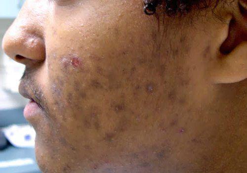 Как убрать возрастные пигментные пятна. Старческие пятна на лице: лечение 05