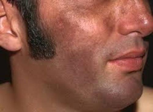 Как убрать возрастные пигментные пятна. Старческие пятна на лице: лечение 09