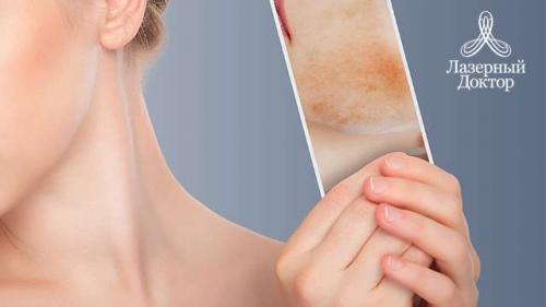 Как убрать возрастные пигментные пятна. Старческие пятна на лице: лечение 01
