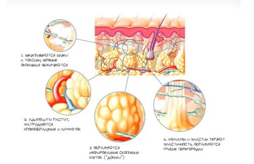 Как избавиться от целлюлита в домашних условиях. Почему появляется целлюлит