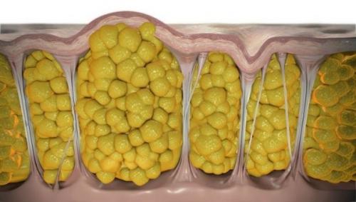 Как избавиться от целлюлита в домашних условиях. Почему появляется целлюлит