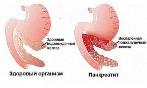 Что пить натощак при панкреатите. Панкреатит – кратко о заболевании