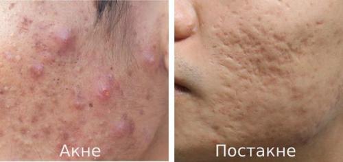 Чем можно убрать пятна на лице после прыщей. Что такое постакне 02 Чем можно убрать пятна на лице после прыщей. Что такое постакне 02