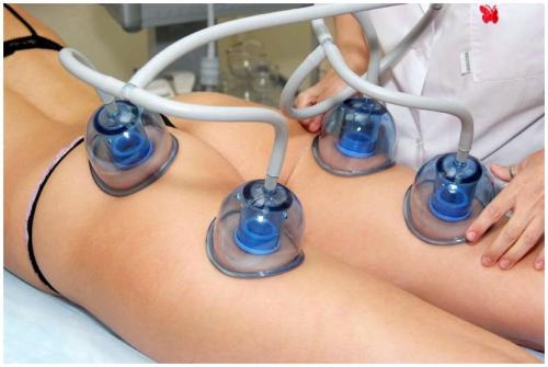 Баночный массаж против целлюлита. Как ставить банки: главные правила 03