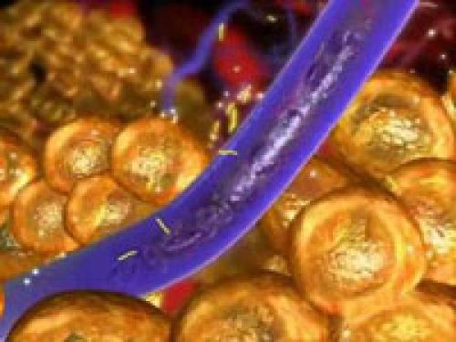 В чем отличие ультразвуковой липосакции от традиционной 04