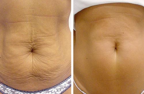 В чем отличие ультразвуковой липосакции от традиционной 01