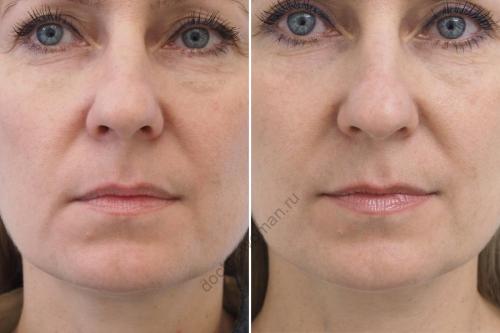 Как убрать мешки под глазами в домашних условиях навсегда. Мешки под глазами: как избавиться от сомнительного украшения