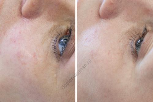 Как убрать мешки под глазами в домашних условиях навсегда. Мешки под глазами: как избавиться от сомнительного украшения