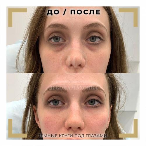 Как убрать темные круги под глазами за 5 минут. Разбираемся в причинах проблемы.