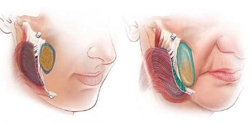 Гравитационный птоз нижней трети лица и верхнего века. Определение болезни. Причины заболевания 04
