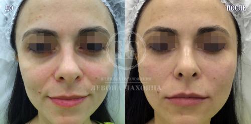 Как убрать темные круги под глазами за 5 минут. Разбираемся в причинах проблемы.