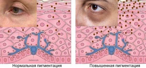 Как убрать тёмные круги под глазами. Косметологические методы избавления от тёмных кругов под глазами 11 Как убрать тёмные круги под глазами. Косметологические методы избавления от тёмных кругов под глазами 11