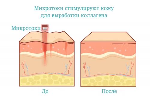 Какие ощущения возникают во время и после процедуры. Как работает косметическая процедура