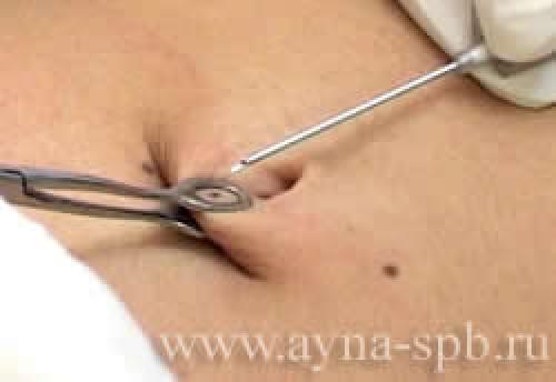 Противопоказания к пирсингу пупка. Этапы пирсинга пупка 06 Противопоказания к пирсингу пупка. Этапы пирсинга пупка 06