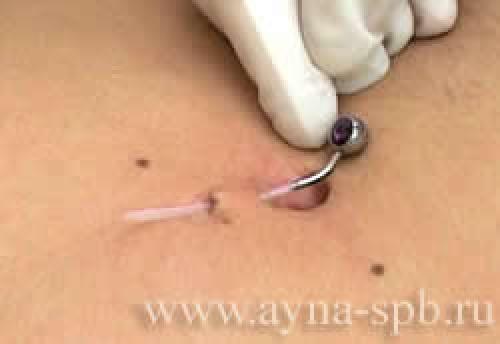 Противопоказания к пирсингу пупка. Этапы пирсинга пупка 07 Противопоказания к пирсингу пупка. Этапы пирсинга пупка 07