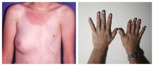 Как вернуть грудь после похудения. Почему обвисает грудь? 02 Как вернуть грудь после похудения. Почему обвисает грудь? 02