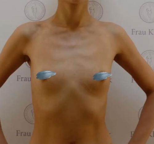 Как вернуть грудь после похудения. Почему обвисает грудь? 06 Как вернуть грудь после похудения. Почему обвисает грудь? 06