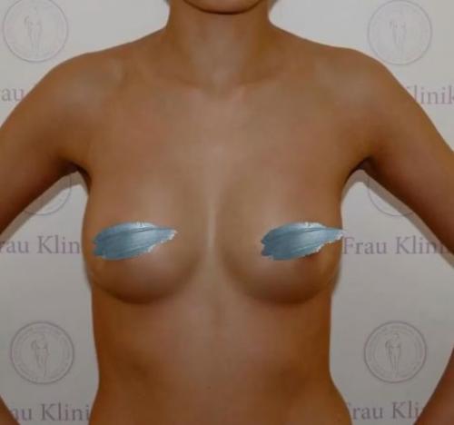 Как вернуть грудь после похудения. Почему обвисает грудь? 08 Как вернуть грудь после похудения. Почему обвисает грудь? 08