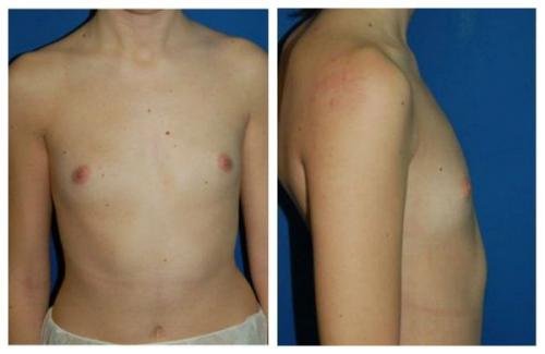 Как вернуть грудь после похудения. Почему обвисает грудь? 01 Как вернуть грудь после похудения. Почему обвисает грудь? 01