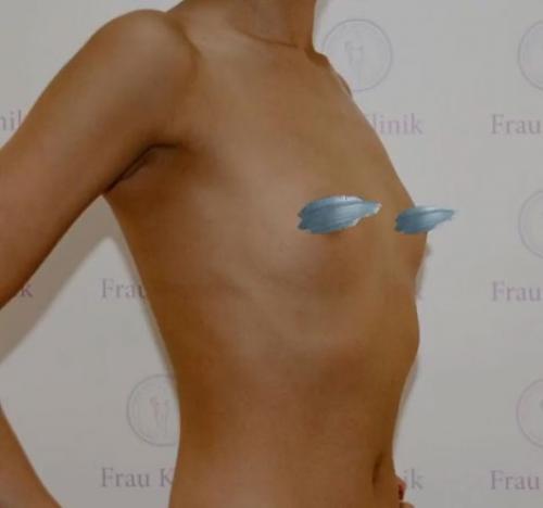 Как вернуть грудь после похудения. Почему обвисает грудь? 05 Как вернуть грудь после похудения. Почему обвисает грудь? 05