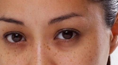 Как убрать темные круги под глазами быстро. Как убрать круги филлерами. 18 Как убрать темные круги под глазами быстро. Как убрать круги филлерами. 18