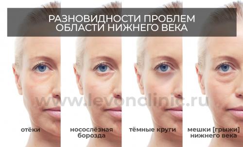 Как убрать темные круги под глазами быстро. Как убрать круги филлерами. 09 Как убрать темные круги под глазами быстро. Как убрать круги филлерами. 09