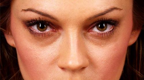 Как убрать темные круги под глазами быстро. Как убрать круги филлерами. 17 Как убрать темные круги под глазами быстро. Как убрать круги филлерами. 17