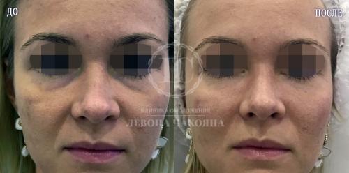 Убрать темные круги под глазами косметология. Разбираемся в причинах проблемы.